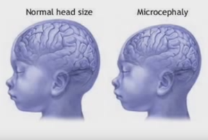 microcephaly baby head pictures