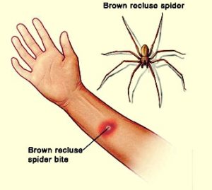 brown-recluse-bite-pictures