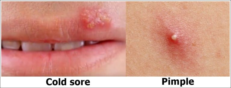 cold-sore-or-pimple-pictures-how-to-identify-them